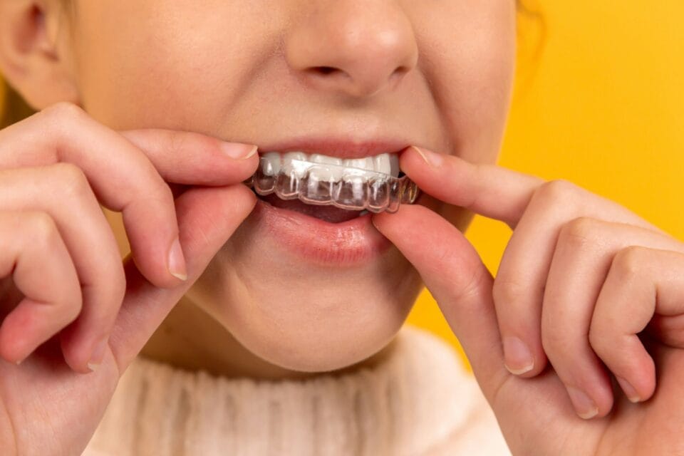 Une fille met sa gouttière invisalign en place