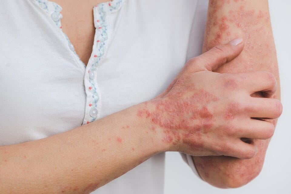 Bras avec éruption cutanée et plaques rouges