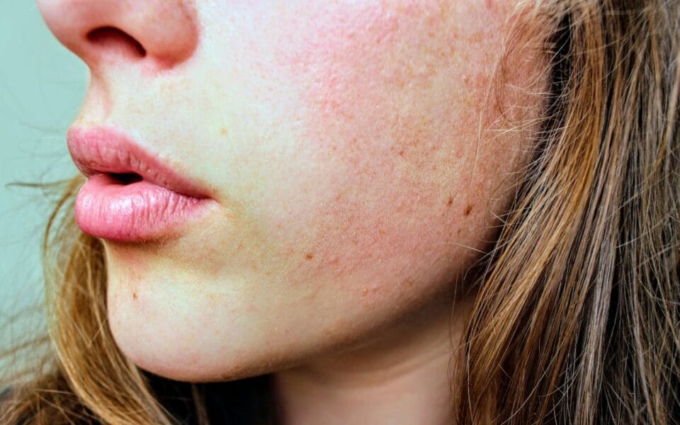 Gros plan de peau avec acné sur visage féminin